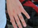 Jenner’s ring