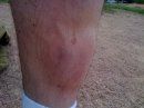 jim-bruise-leg1